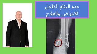 عدم التئام الكاحل الاعراض والعلاج للدكتور احمد العطار