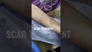 Fractional Co2 laser Resurfacing for getting rid of scars