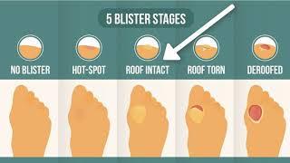 How To Treat A Blister Correctly (First, Look At Your Blister Roof)