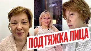 Подтяжка лица фото до и после операции