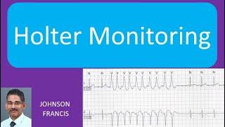 Holter Monitoring