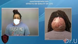 Los Angeles Man Finally Gets Rid of HUGE Bump on the Back of the Head | By Dr Bumpinator