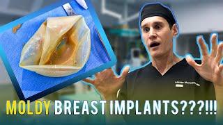 Forever Love? Unveiling the Truth about Breast Implants Removal