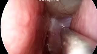 Huge nasal polyps with obstruction.