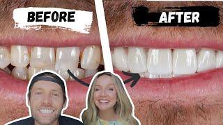 My husband flew to Turkey for a new smile! (Crowns + 7 root canals!)