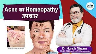 Acne का Homeopathy उपचार || Acne ka homeopathy upchaar #acne