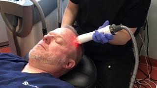 Vivace RF Microneedling for Younger Skin and Facial Rejuvenation