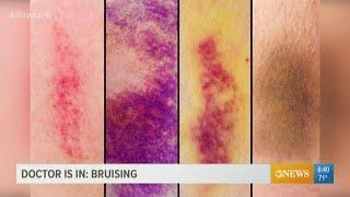 Why bruising matters and what the purple, blue, and yellow marks can indicate