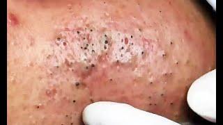 Extreme Deep Blackhead Removal - Best Blackhead Extraction Videos