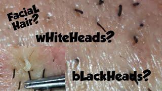 Whiteheads or hair removal?? Watch Now!!