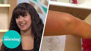 Woman Allergic To Water Can't Have A Shower Without Sparking Physical Agony | This Morning