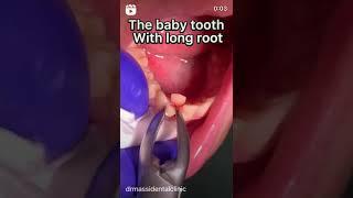 Baby tooth ?!not lose !#video #trending #tiktok #fyp #viral #shorts #youtubeshorts #youtube #love #f