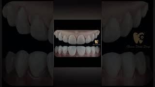 veneers #dentalassistant #dentist #dentaldesign #dentistry #dentalimplant