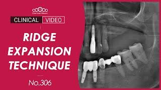 Ridge Expansion with Simultaneous Placement [Dr. Jeon Inseong]