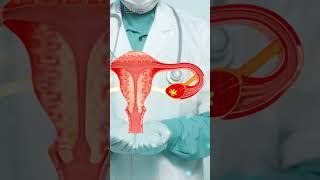 Stage 3 Ovarian Cancer Explained: Symptoms, Diagnosis, and Treatment