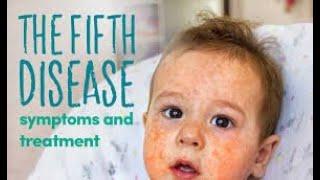 ERYTHEMA INFECTIOSUM | PARVOVIRUS B19 | FIFTH DISEASE | slapped cheek syndrome