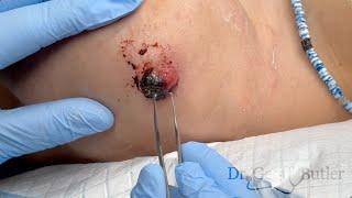 Removal of a Pyogenic granuloma on the shoulder