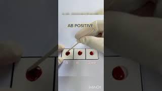 AB positive blood group 