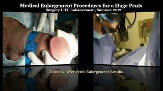 Medical Enlargement Procedures for a Huge Penis