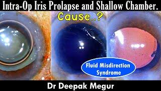 Intra-Op Iris Prolapse and Shallow Chamber ...Cause..? - Dr Deepak Megur