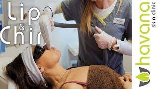 Laser Hair Removal | Lip & Chin