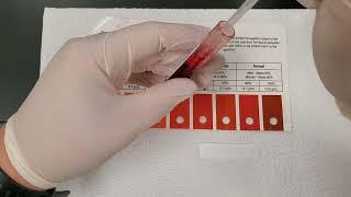 Tallquist Method for Determining Hemoglobin Content