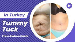 Tummy Tuck in Turkey (Cost, Reviews, Results, Before, After) - Flora Clinic