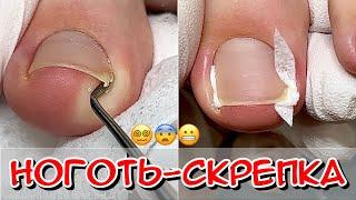 Nail - paperclip / Ingrown toenail / Ingrown toe / What to do / Ingrown toenail