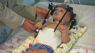 Toddler's head reattached by doctors in medical miracle