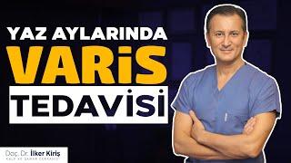 Yaz Aylarında Varis Tedavisi Yapılır mı? | Doç. Dr. İlker Kiriş