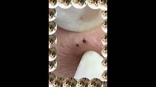 Pimple Popping, Ingrown Hair Removal & Blackhead Extractions | Ultimate Skincare very satisfying