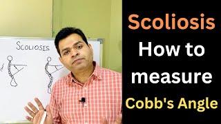 Scoliosis, How to Measure Cobb's Angle, Scoliosis Treatment, Spine Deformities