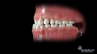 Anterior Crossbite: Skeletal or Functional