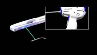 The UroLift® System Device Deployment