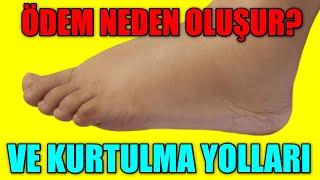 ÖDEM NEDEN OLUŞUR VE KURTULMA YOLLARI