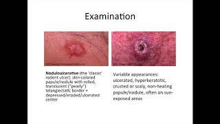 Dermatology - basal cell carcinoma and squamous cell carcinoma