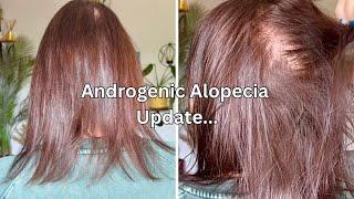 Experiencing Increased Hair Shedding With Minoxidil Treatment | Androgenic Alopecia Update