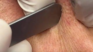 粉刺來了 Removing Ear Blackheads - 澄熒SPA