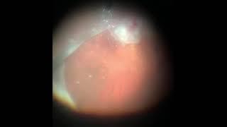 Vitrectomy + Silicone oil Tamponade for endophthalmitis. Витрэктомия+Силикон по поводу эндофтальмита