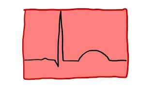 Po mojemu: EKG cz. 1