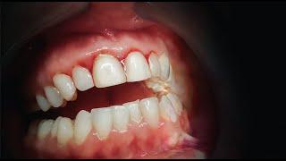 Get Rid Of Gum Disease FOR GOOD!