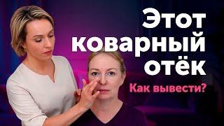 Почему ЭТОТ ОТЁК НЕ УХОДИТ? Разбор реального случая