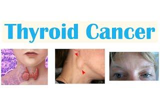 Thyroid Cancer (Papillary, Follicular, Medullary & Anaplastic) | Symptoms, Diagnosis, Treatment