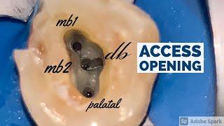 Maxillary Molar Access Opening (MB2)