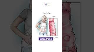 What Are The Tests For Colon Cancer? - SSO Hospital