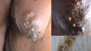 Maggots inside the breast of a 70 year old African woman (furuncular breast myiasis)