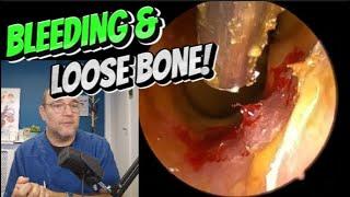 BLEEDING AND LOOSE BONE! 387 #ear #earwax #earwaxremoval #asmr #satisfying #foryou #fyp #foryourpage