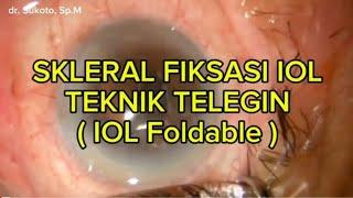 TELEGIN TECHNIQUE SCLERAL FIXATION #1  dr. Sukoto, Sp.M