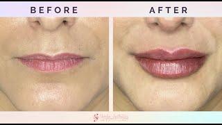 THE RUSSIAN LIP TECHNIQUE AT SKINLY AESTHETICS