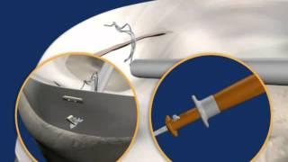 FAST FIX 360 ANIMATION - Smith & Nephew